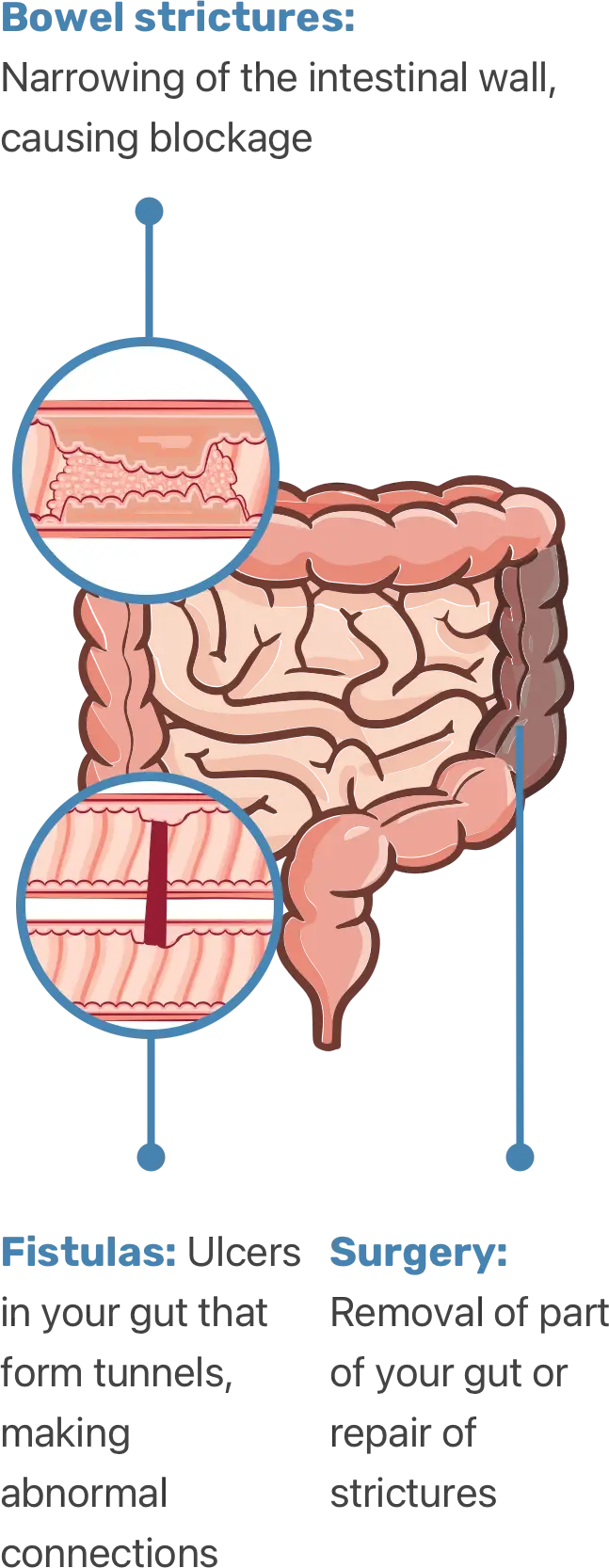 Bowel strictures, surgery, and fistulas.